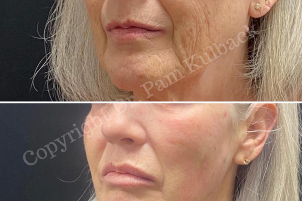 CoolPeel™ Top Skin Resurfacing Laser