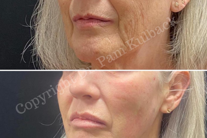 CoolPeel™ Top Skin Resurfacing Laser